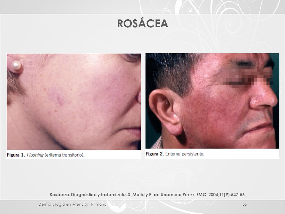 ROSÁCEA Rosácea: Diagnóstico y tratamiento. S. Mallo y P. de Unamuno Pérez. FMC. 2004;11(9):
