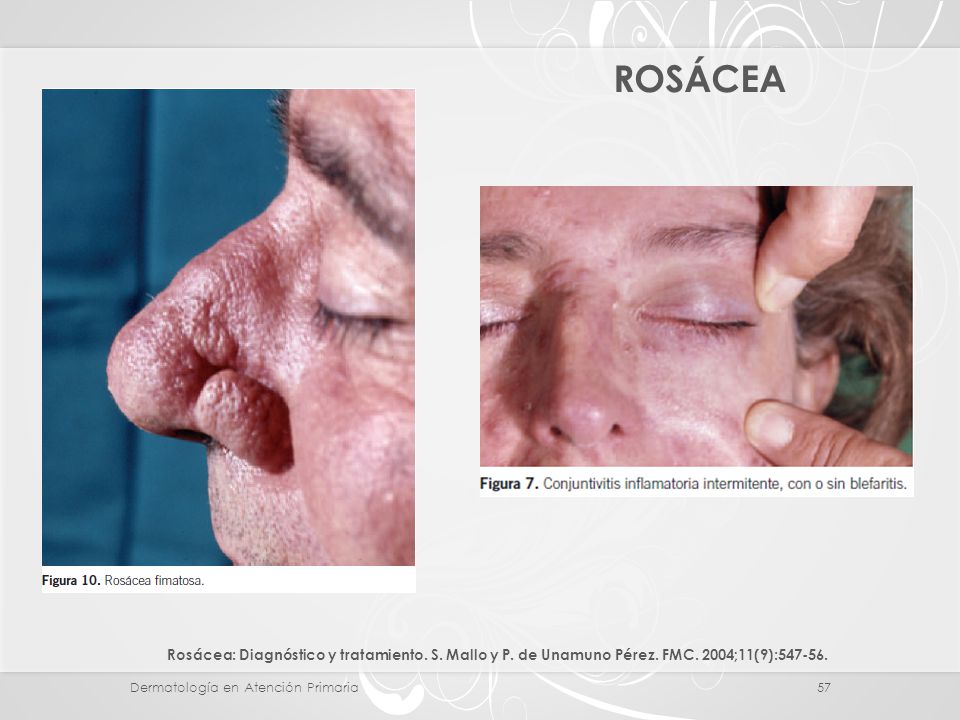 ROSÁCEA Rosácea: Diagnóstico y tratamiento. S. Mallo y P. de Unamuno Pérez. FMC. 2004;11(9):