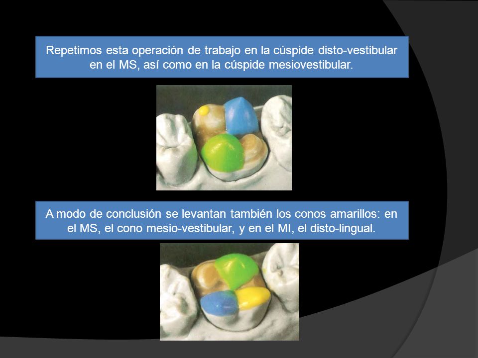 Repetimos esta operación de trabajo en la cúspide disto-vestibular en el MS, así como en la cúspide mesiovestibular.