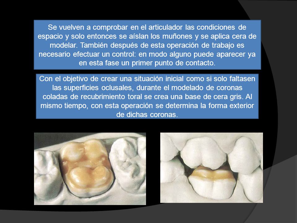 Se vuelven a comprobar en el articulador las condiciones de espacio y solo entonces se aíslan los muñones y se aplica cera de modelar. También después de esta operación de trabajo es necesario efectuar un control: en modo alguno puede aparecer ya en esta fase un primer punto de contacto.