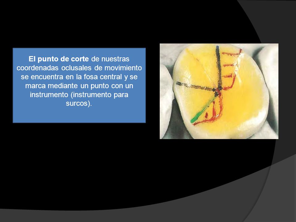 El punto de corte de nuestras coordenadas oclusales de movimiento se encuentra en la fosa central y se marca mediante un punto con un instrumento (instrumento para surcos).