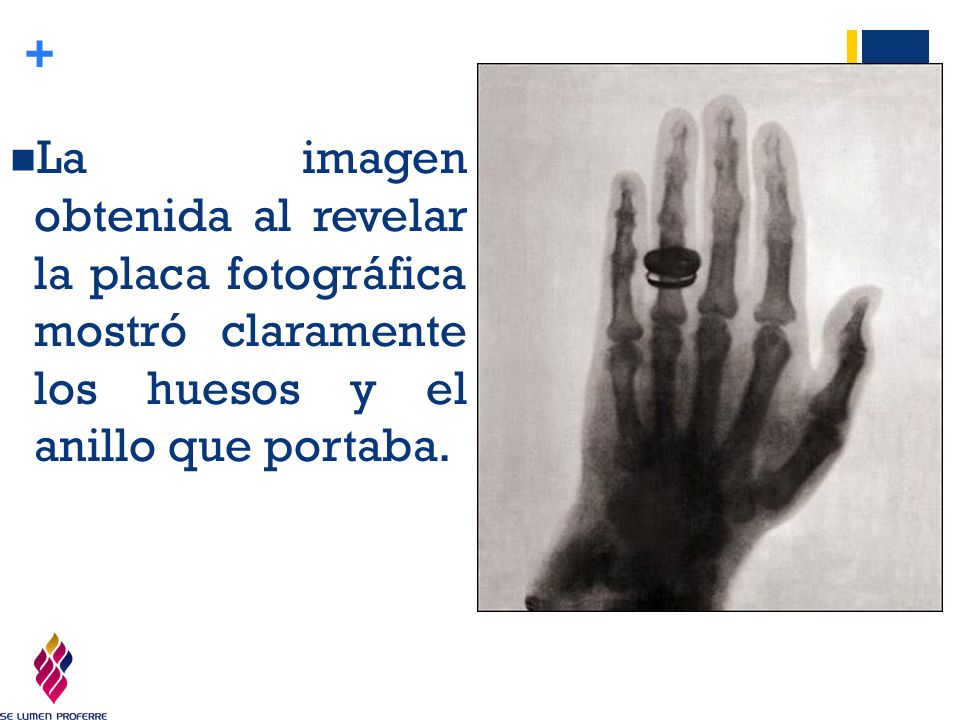 La imagen obtenida al revelar la placa fotográfica mostró claramente los huesos y el anillo que portaba.