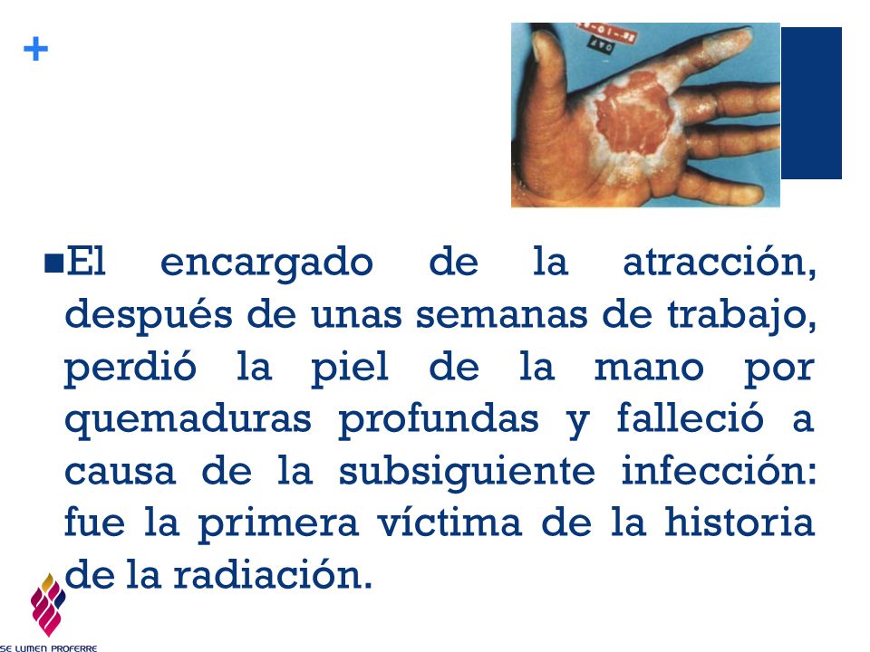 El encargado de la atracción, después de unas semanas de trabajo, perdió la piel de la mano por quemaduras profundas y falleció a causa de la subsiguiente infección: fue la primera víctima de la historia de la radiación.