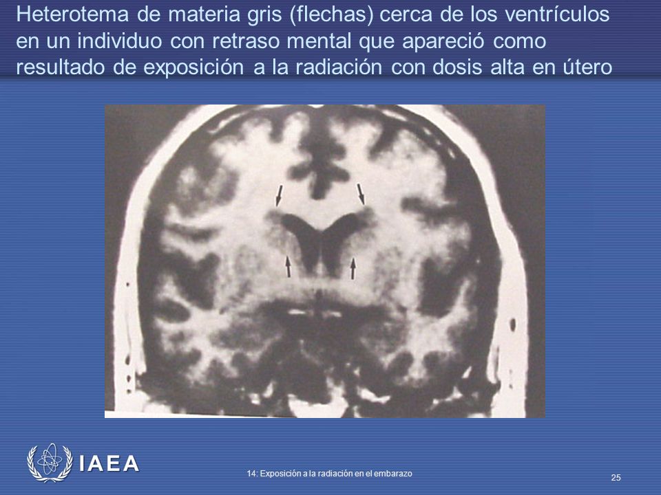 Heterotema de materia gris (flechas) cerca de los ventrículos en un individuo con retraso mental que apareció como resultado de exposición a la radiación con dosis alta en útero
