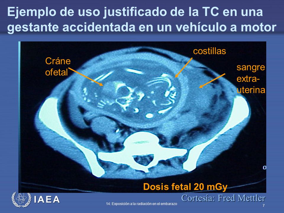 Ejemplo de uso justificado de la TC en una gestante accidentada en un vehículo a motor