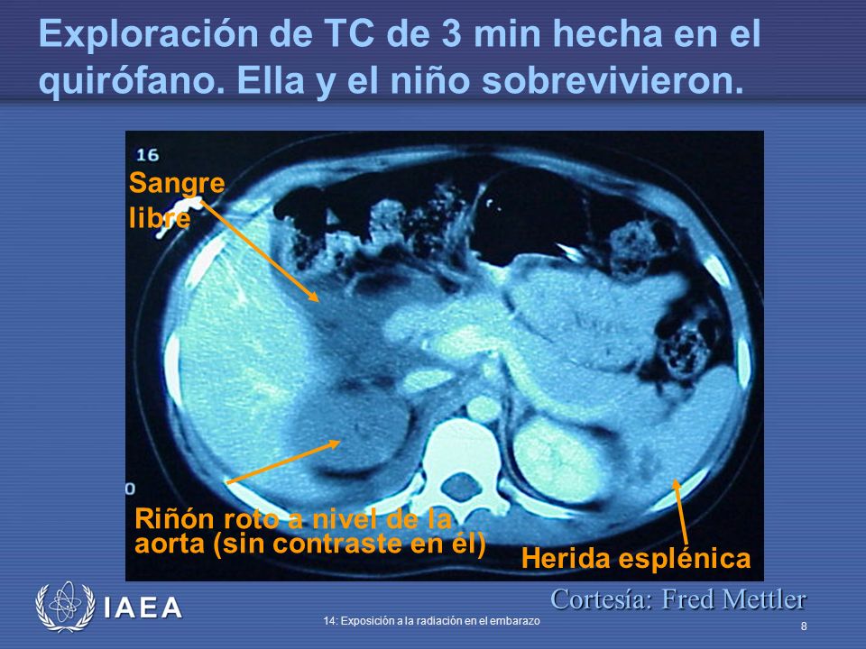 Exploración de TC de 3 min hecha en el quirófano