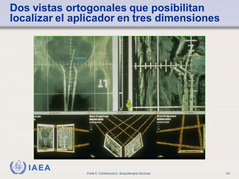 Dos vistas ortogonales que posibilitan localizar el aplicador en tres dimensiones