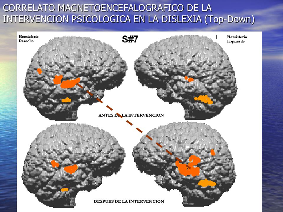CORRELATO MAGNETOENCEFALOGRAFICO DE LA INTERVENCION PSICOLOGICA EN LA DISLEXIA (Top-Down)