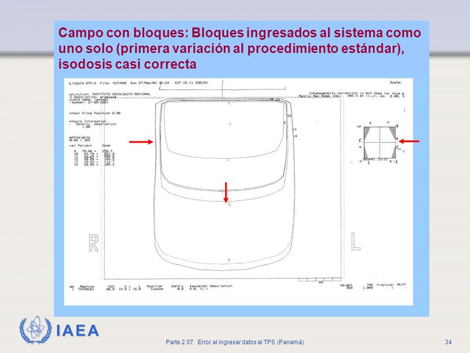 Campo con bloques: Bloques ingresados al sistema como uno solo (primera variación al procedimiento estándar), isodosis casi correcta