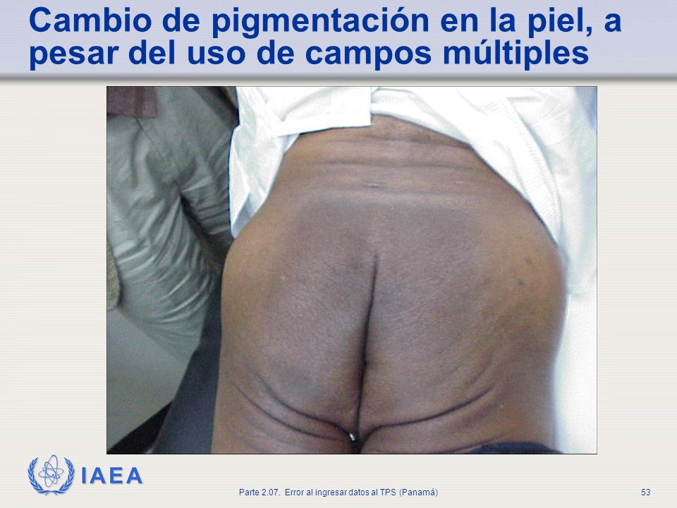 Cambio de pigmentación en la piel, a pesar del uso de campos múltiples