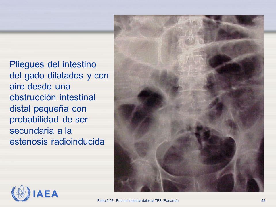 Pliegues del intestino del gado dilatados y con aire desde una obstrucción intestinal distal pequeña con probabilidad de ser secundaria a la estenosis radioinducida