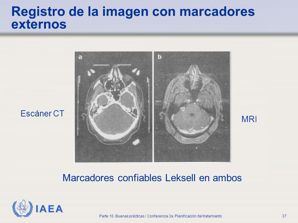 Registro de la imagen con marcadores externos
