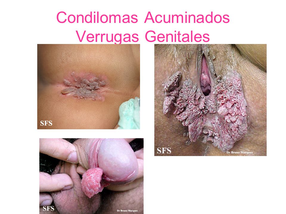 Condilomas Acuminados Verrugas Genitales