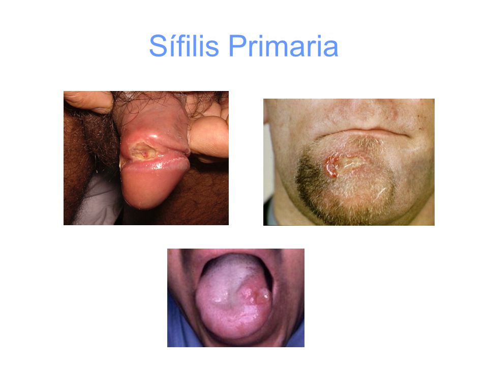 Sífilis Primaria