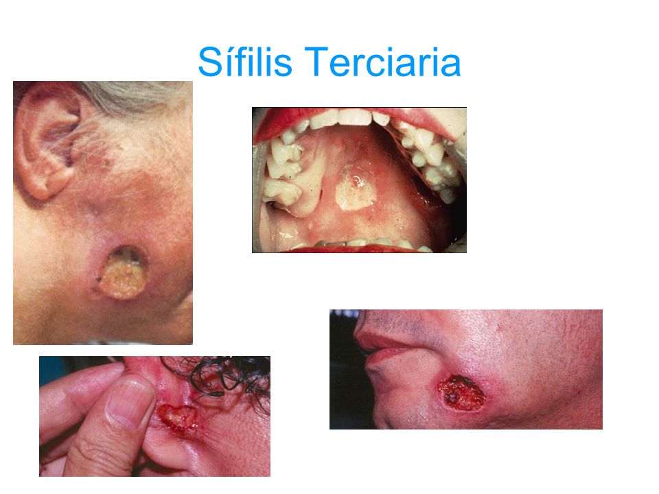 Sífilis Terciaria