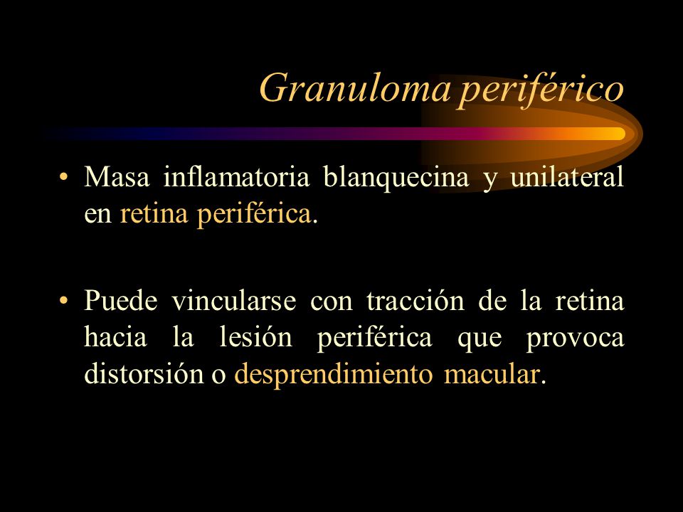 Granuloma periférico Masa inflamatoria blanquecina y unilateral en retina periférica.
