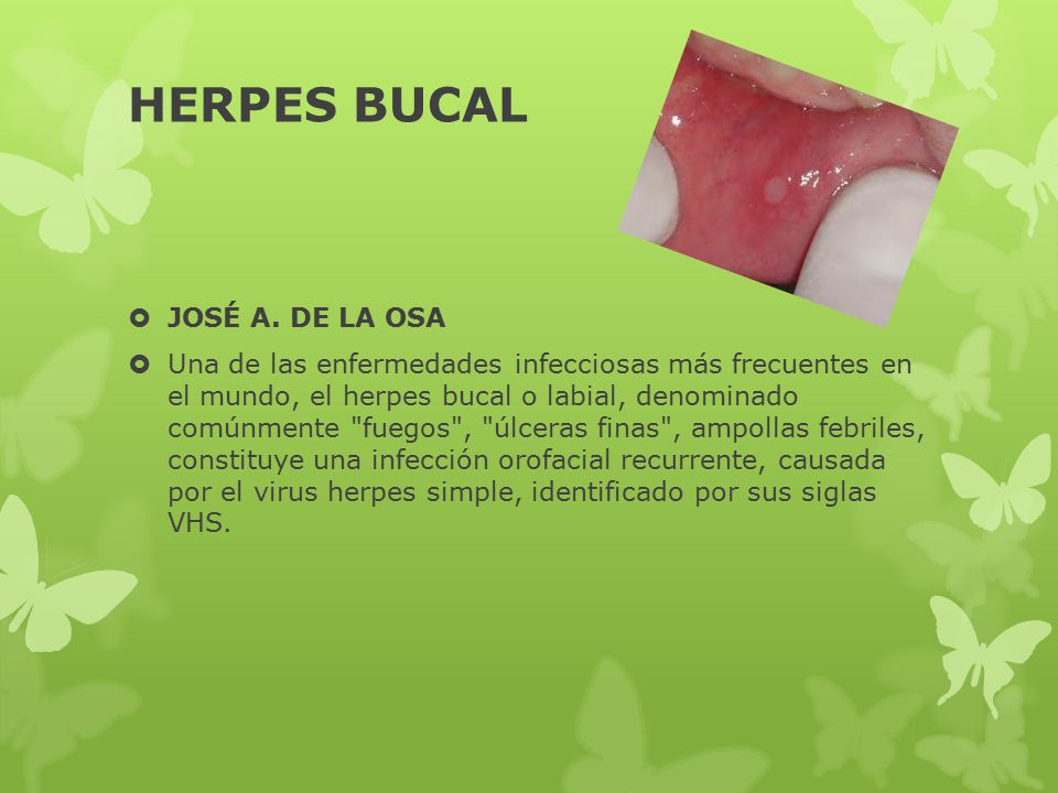 HERPES BUCAL JOSÉ A. DE LA OSA