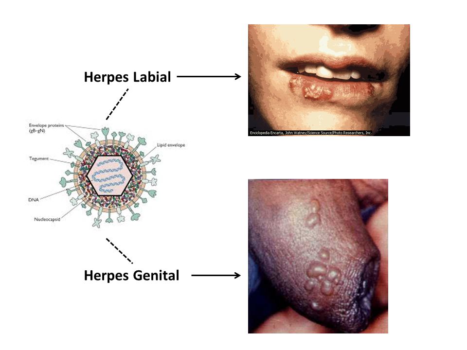 Herpes Labial Herpes Genital