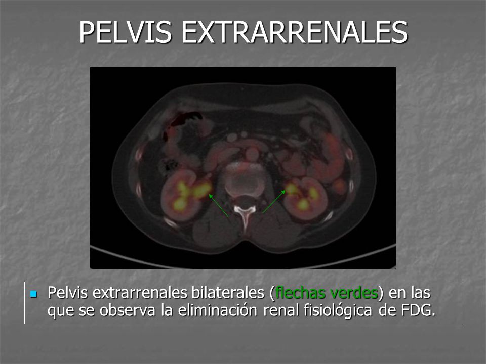 PELVIS EXTRARRENALES Pelvis extrarrenales bilaterales (flechas verdes) en las que se observa la eliminación renal fisiológica de FDG.
