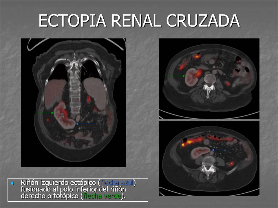ECTOPIA RENAL CRUZADA Riñón izquierdo ectópico (flecha azul) fusionado al polo inferior del riñón derecho ortotópico (flecha verde).