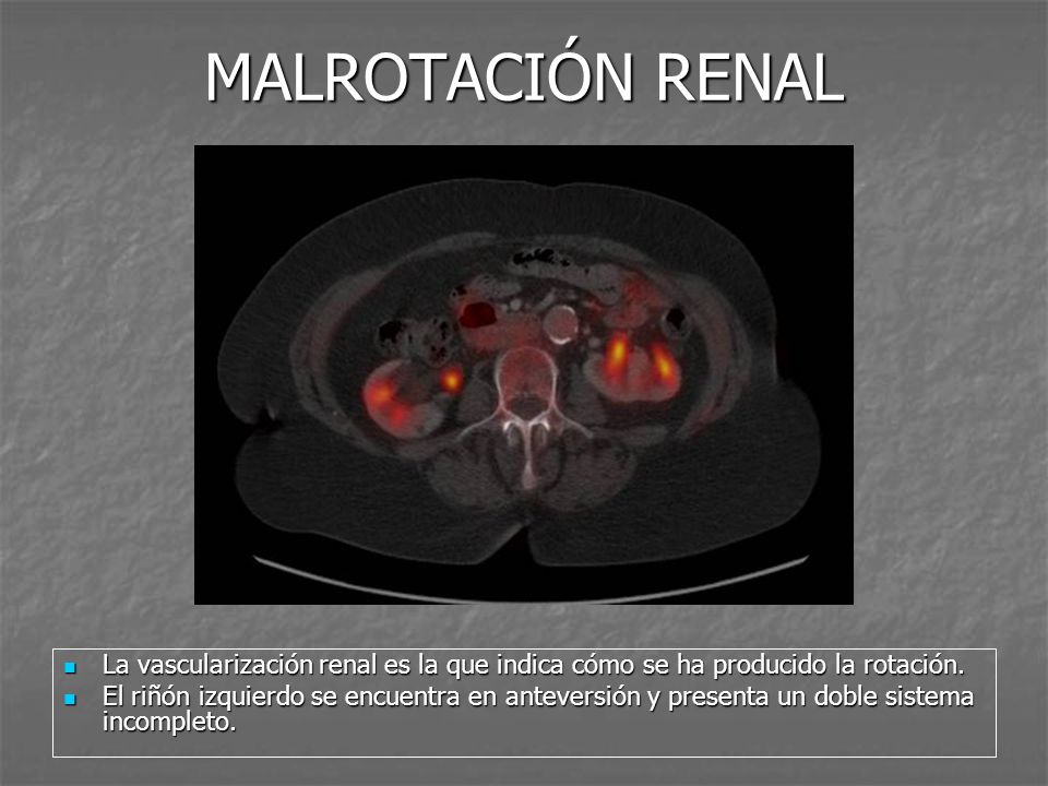 MALROTACIÓN RENAL La vascularización renal es la que indica cómo se ha producido la rotación.