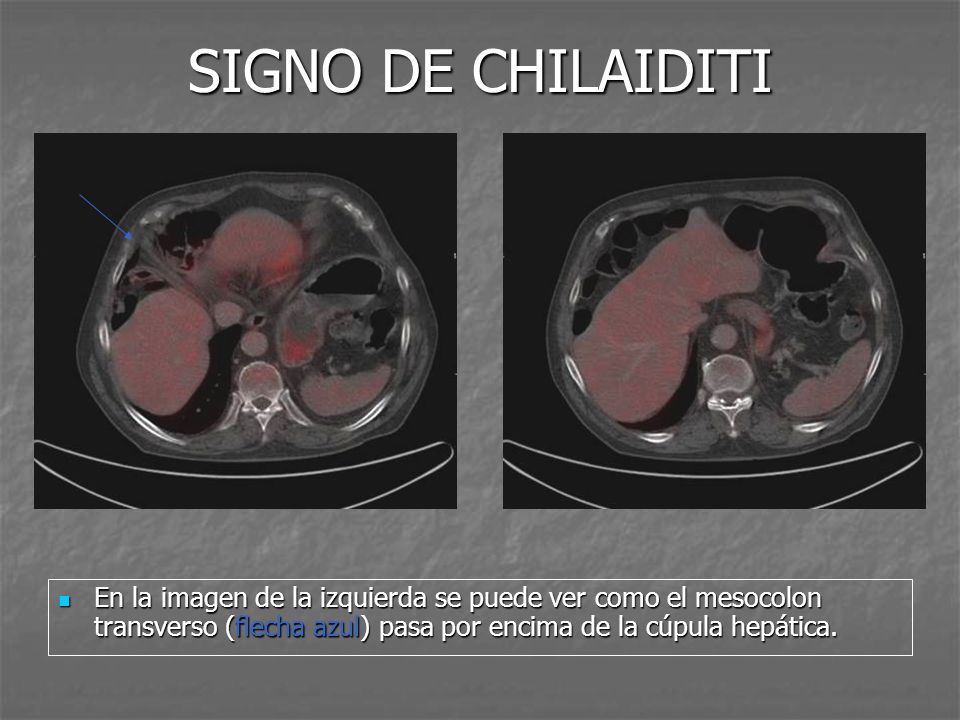 SIGNO DE CHILAIDITI En la imagen de la izquierda se puede ver como el mesocolon transverso (flecha azul) pasa por encima de la cúpula hepática.