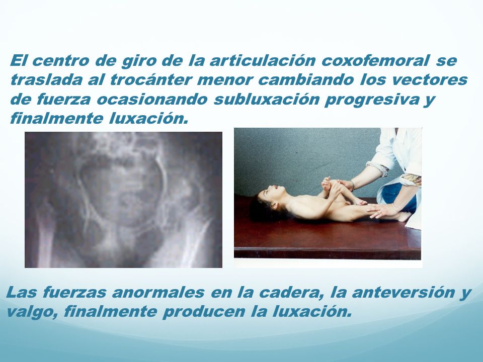 El centro de giro de la articulación coxofemoral se traslada al trocánter menor cambiando los vectores de fuerza ocasionando subluxación progresiva y finalmente luxación.