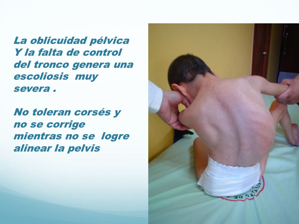 La oblicuidad pélvica Y la falta de control del tronco genera una escoliosis muy severa .