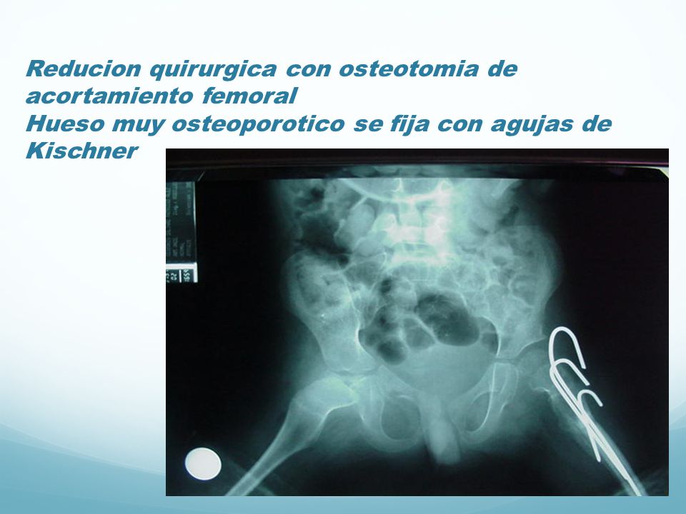 Reducion quirurgica con osteotomia de acortamiento femoral