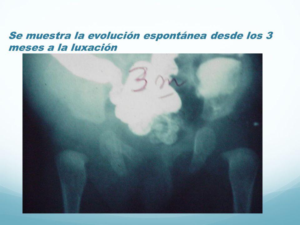 Se muestra la evolución espontánea desde los 3 meses a la luxación