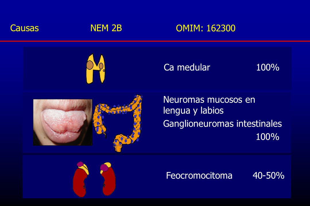 Causas NEM 2B OMIM: Ca medular 100% Neuromas mucosos en lengua y labios.