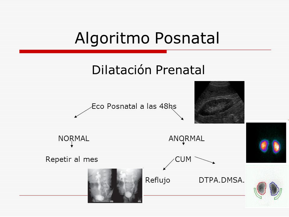 Algoritmo Posnatal Dilatación Prenatal Eco Posnatal a las 48hs