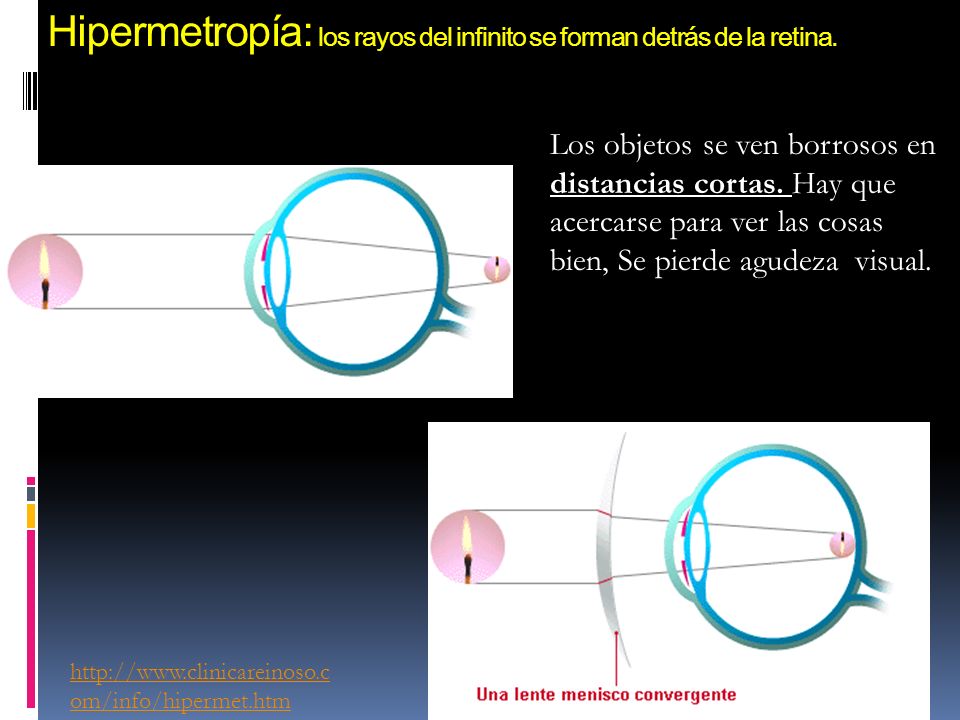 Hipermetropía: los rayos del infinito se forman detrás de la retina.
