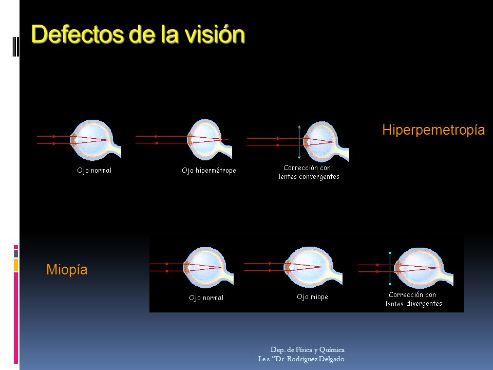 Defectos de la visión Hiperpemetropía Miopía Dep. de Física y Química