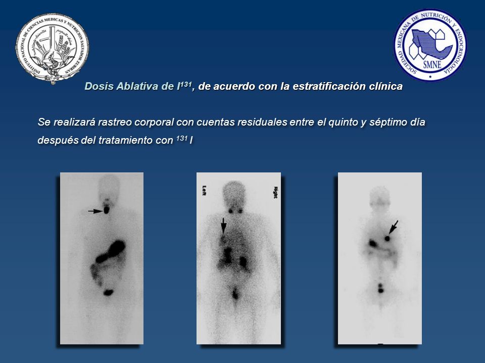 Dosis Ablativa de I131, de acuerdo con la estratificación clínica