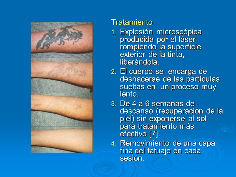 Tratamiento Explosión microscópica producida por el láser rompiendo la superficie exterior de la tinta, liberándola.