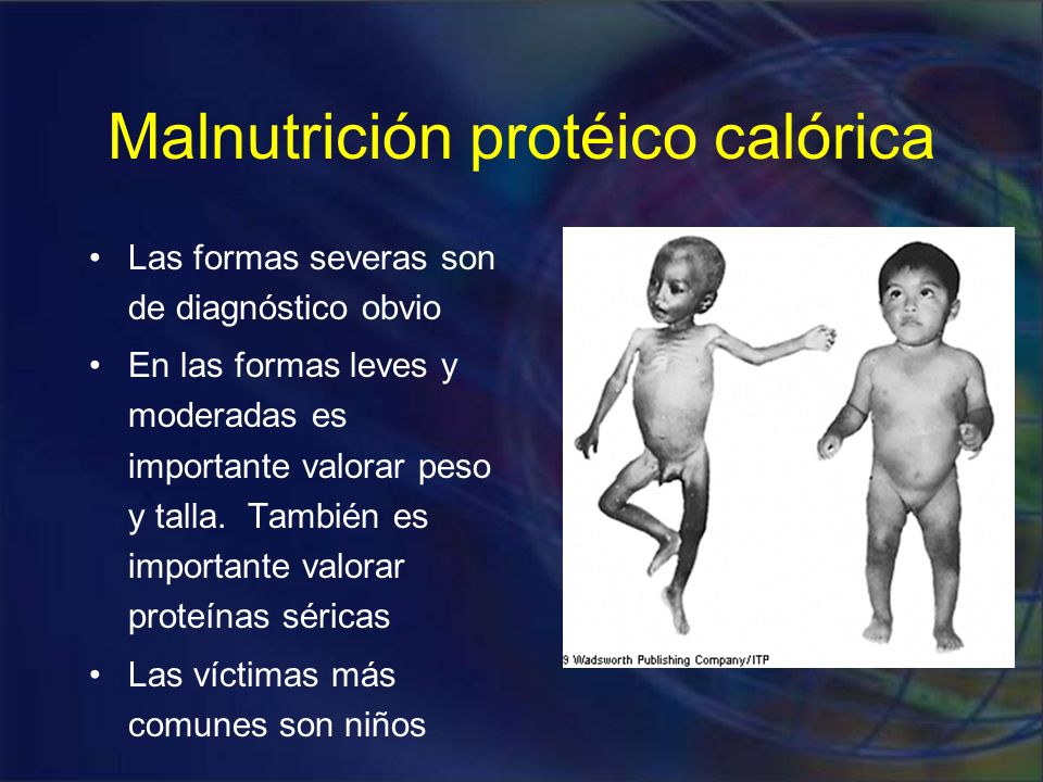 Malnutrición protéico calórica