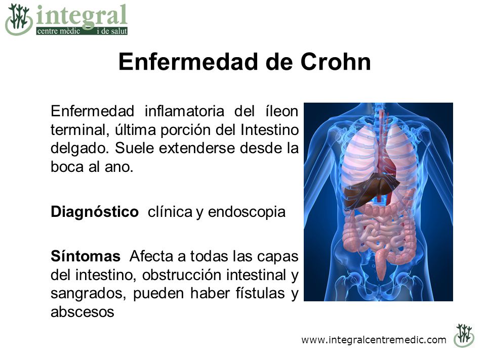 Enfermedad de Crohn Enfermedad inflamatoria del íleon terminal, última porción del Intestino delgado. Suele extenderse desde la boca al ano.