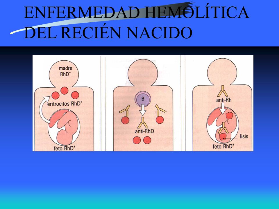 ENFERMEDAD HEMOLÍTICA DEL RECIÉN NACIDO
