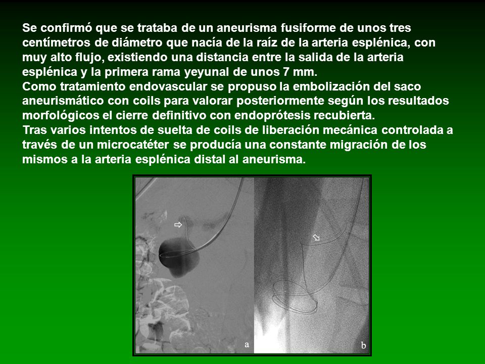 Se confirmó que se trataba de un aneurisma fusiforme de unos tres centímetros de diámetro que nacía de la raíz de la arteria esplénica, con muy alto flujo, existiendo una distancia entre la salida de la arteria esplénica y la primera rama yeyunal de unos 7 mm.