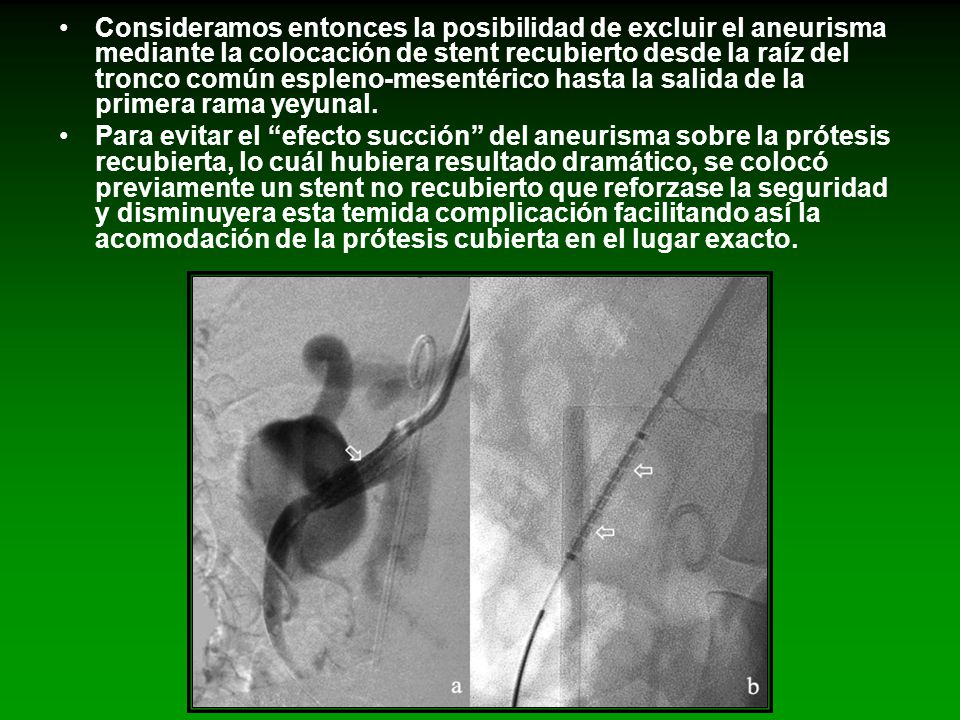 Consideramos entonces la posibilidad de excluir el aneurisma mediante la colocación de stent recubierto desde la raíz del tronco común espleno-mesentérico hasta la salida de la primera rama yeyunal.