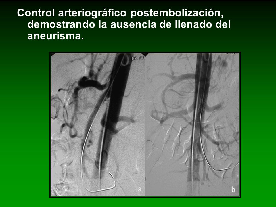 Control arteriográfico postembolización, demostrando la ausencia de llenado del aneurisma.