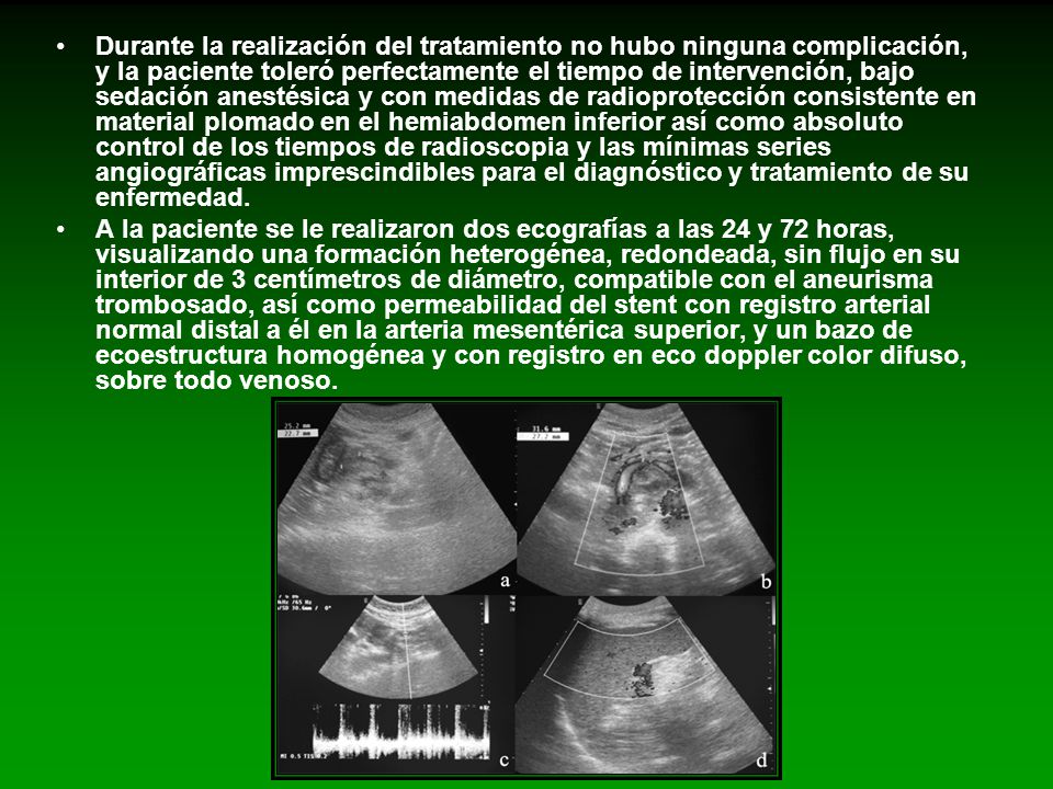 Durante la realización del tratamiento no hubo ninguna complicación, y la paciente toleró perfectamente el tiempo de intervención, bajo sedación anestésica y con medidas de radioprotección consistente en material plomado en el hemiabdomen inferior así como absoluto control de los tiempos de radioscopia y las mínimas series angiográficas imprescindibles para el diagnóstico y tratamiento de su enfermedad.
