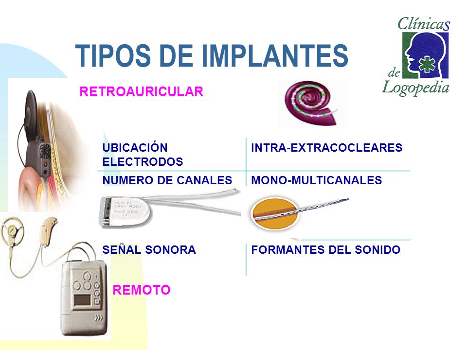 TIPOS DE IMPLANTES RETROAURICULAR REMOTO UBICACIÓN ELECTRODOS