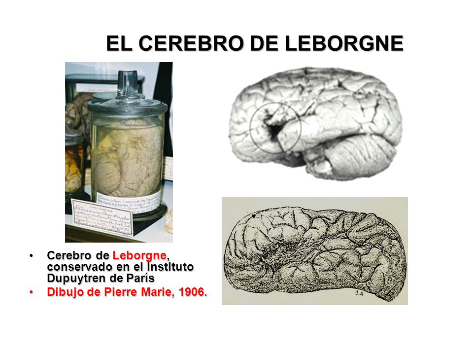 EL CEREBRO DE LEBORGNE Cerebro de Leborgne, conservado en el Instituto Dupuytren de París.
