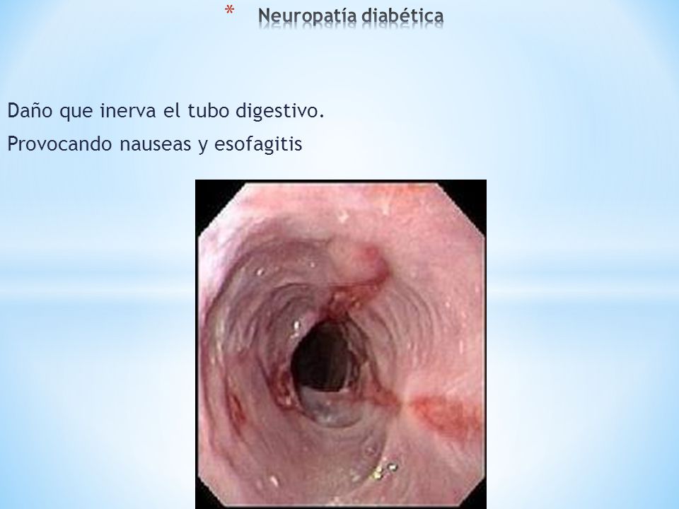 Daño que inerva el tubo digestivo. Provocando nauseas y esofagitis
