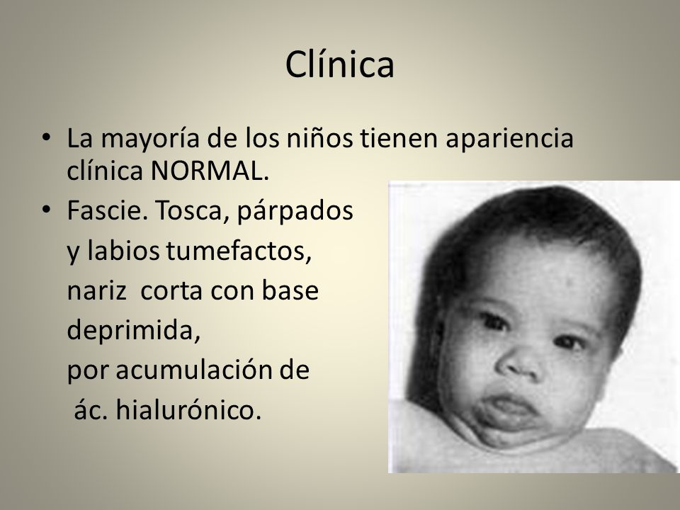 Clínica La mayoría de los niños tienen apariencia clínica NORMAL.