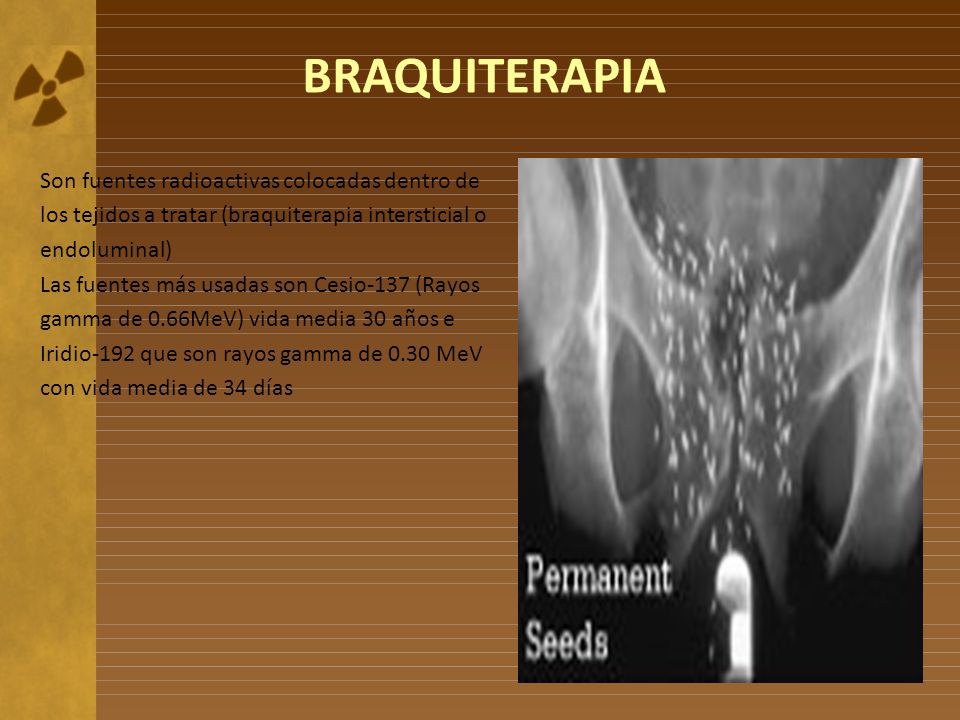 BRAQUITERAPIA Son fuentes radioactivas colocadas dentro de los tejidos a tratar (braquiterapia intersticial o endoluminal)