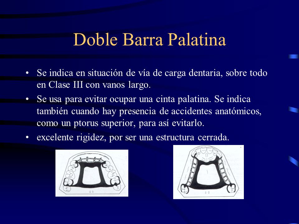 Doble Barra Palatina Se indica en situación de vía de carga dentaria, sobre todo en Clase III con vanos largo.