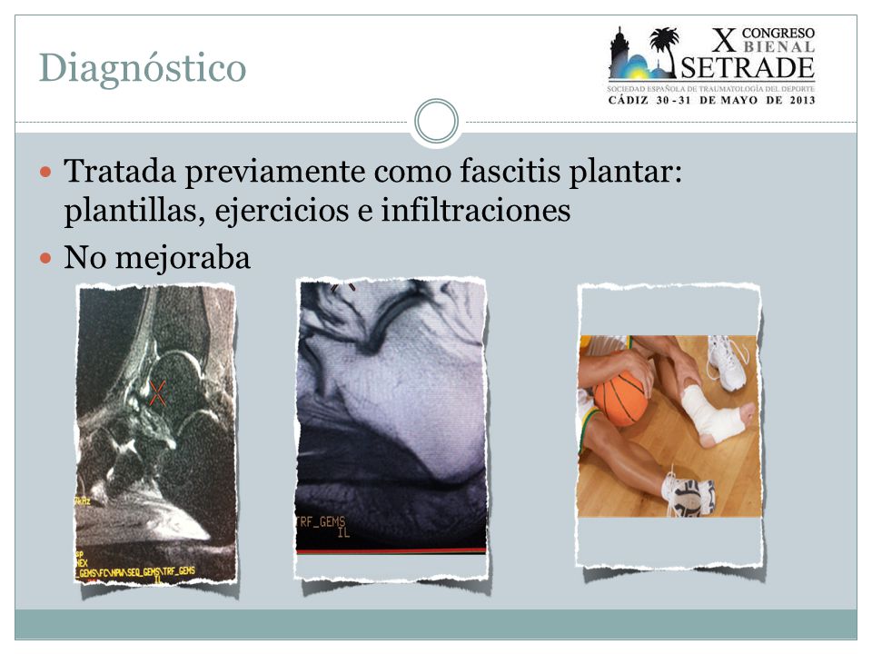Diagnóstico Tratada previamente como fascitis plantar: plantillas, ejercicios e infiltraciones.
